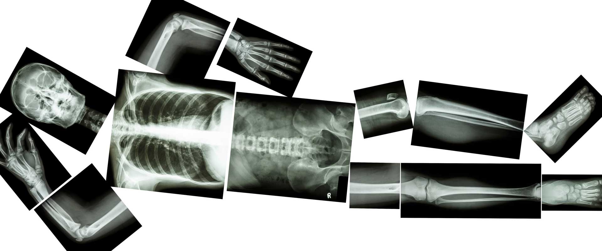 news and events bone plates x-rays pose