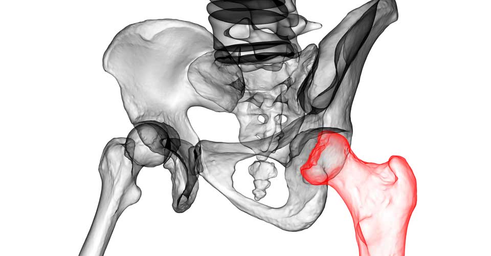 Perthes disease and juvenile ischemic necrosis